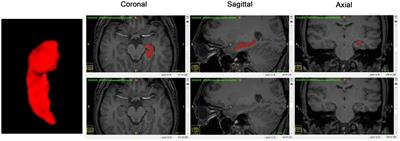 Morphometry Difference of the Hippocampal Formation Between Blind and Sighted Individuals